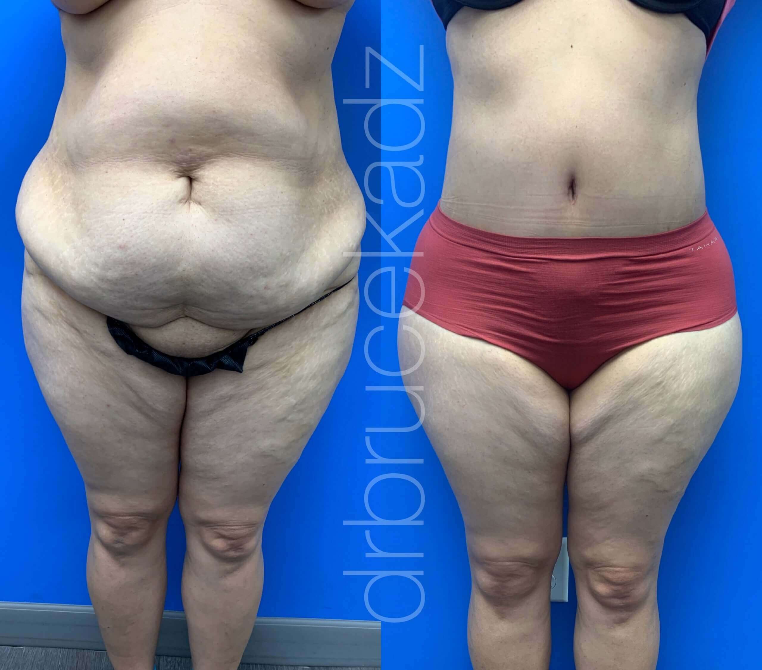 How Much Weight Do You Lose From a Tummy Tuck? - BH Plastic Surgery, image size:2560x2252