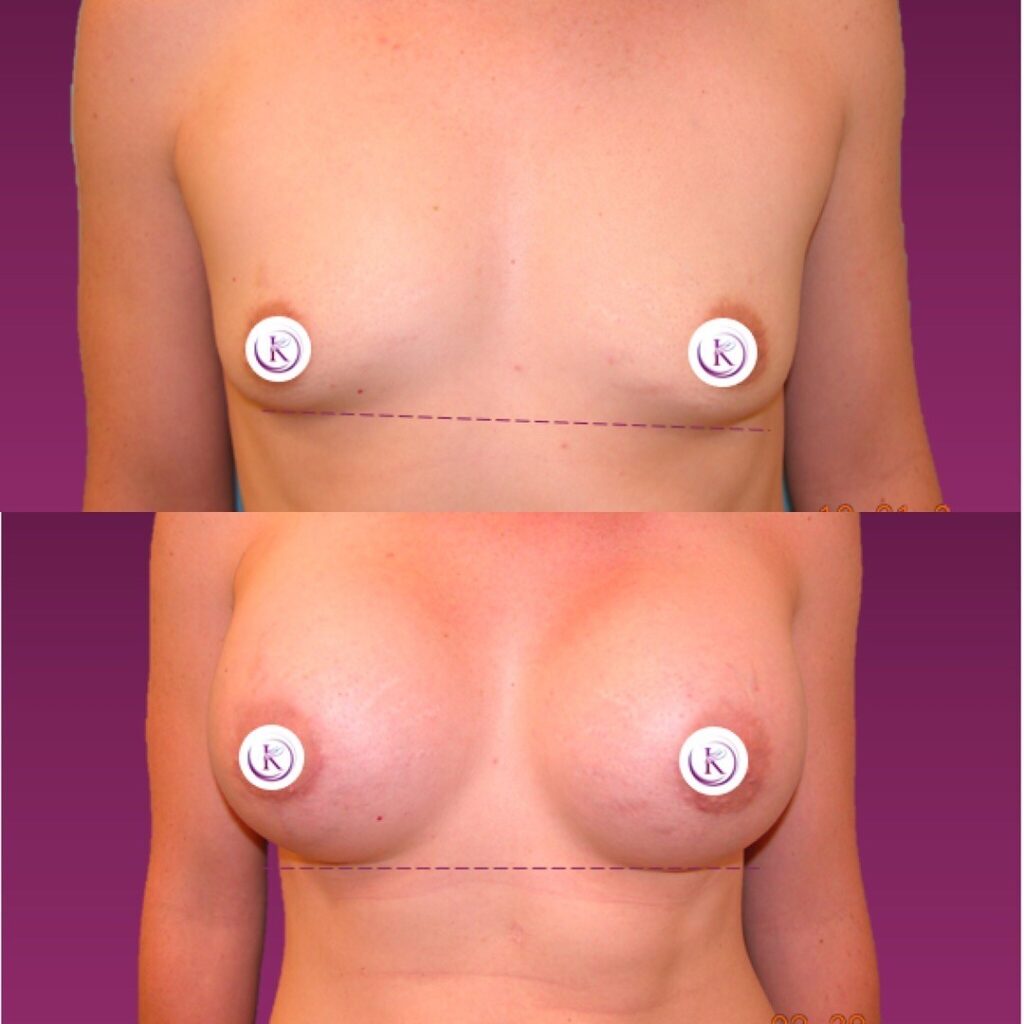 Dr. Bruce Kadz Why Do My Breast Lose Volume & Shape?