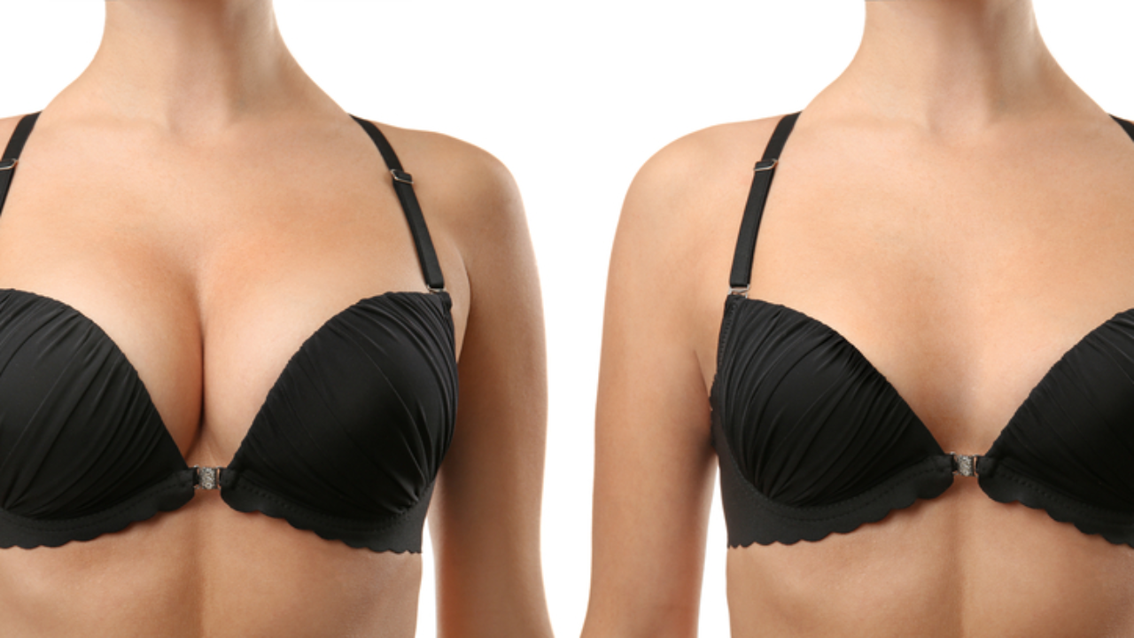 Breast Augmentation With Silicone Implants (B to DDD) - Transformation  Tuesday with Dr. Katzen