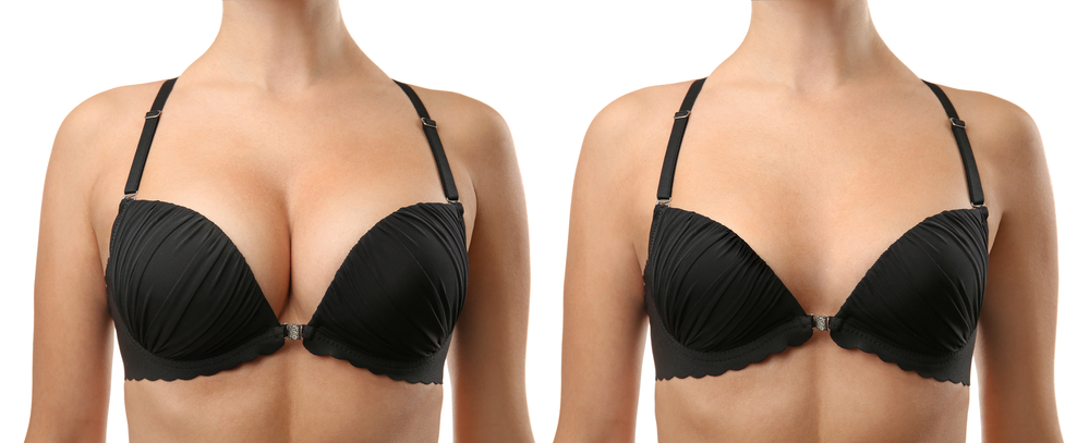 Is Breast Augmentation Permanent 637780781383976646