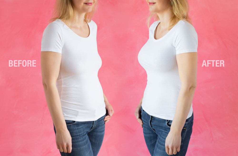 Facts and Myths About Breast Lift Surgery