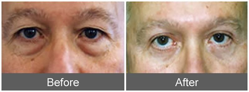 before and after images of an eyelid lift patient in Beverly Hills, CA