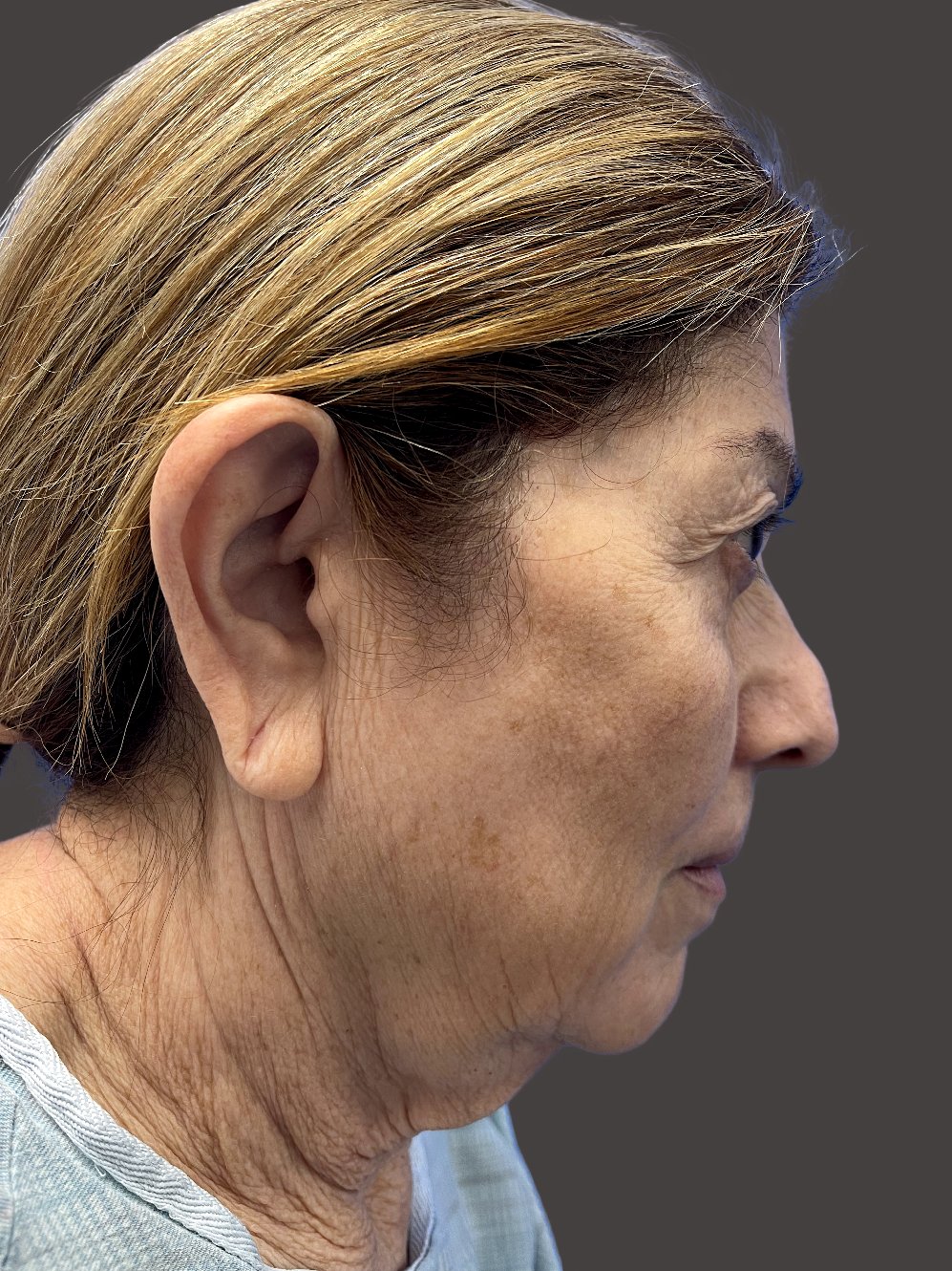 Before Facelift Gallery - Bruce Kadz Beverly Hills Plastic Surgery