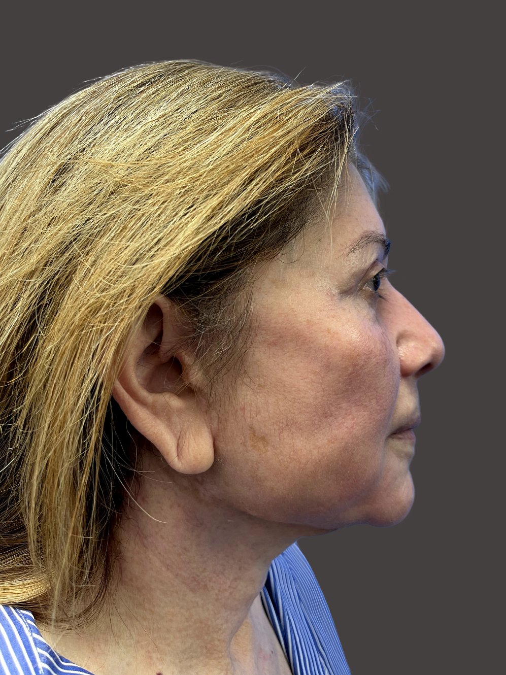After Facelift Gallery - Bruce Kadz Beverly Hills Plastic Surgery