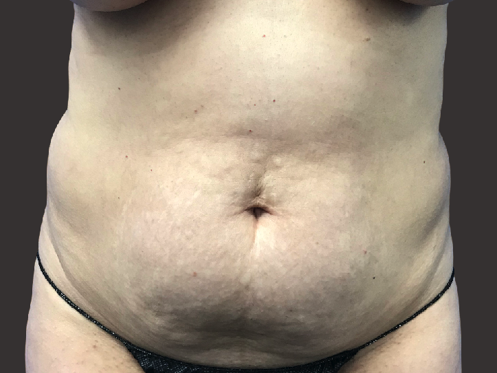 Tummy Tuck Patient Before - 2
