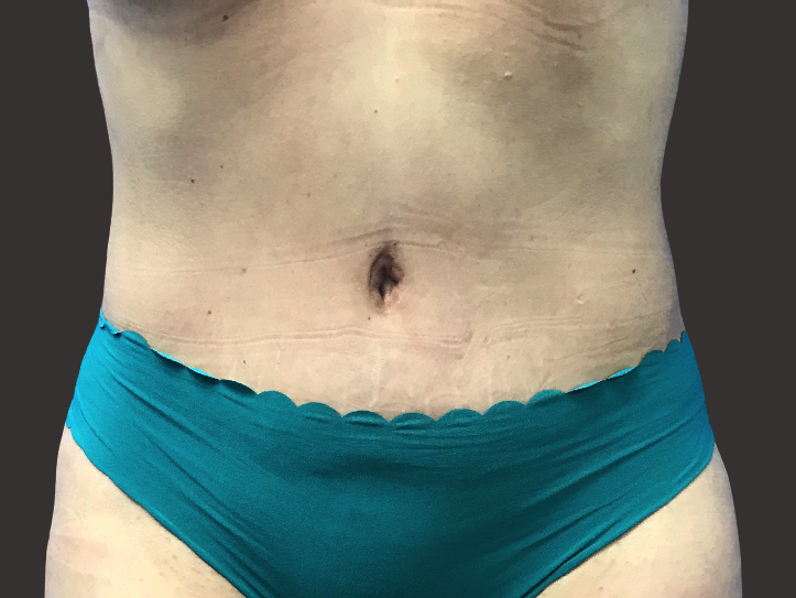 <Tummy Tuck Patient After - 2