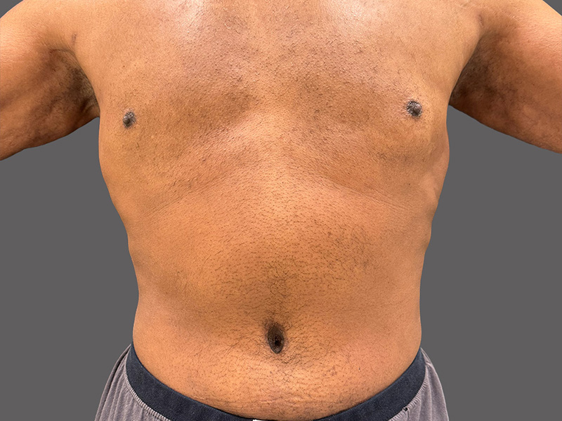 <Liposuction Patient After - 1