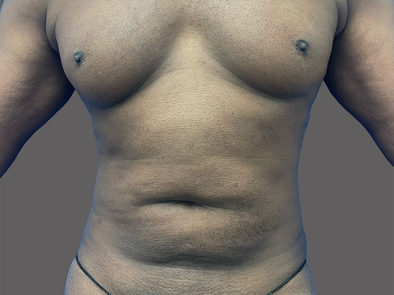 Liposuction Patient Before - 1