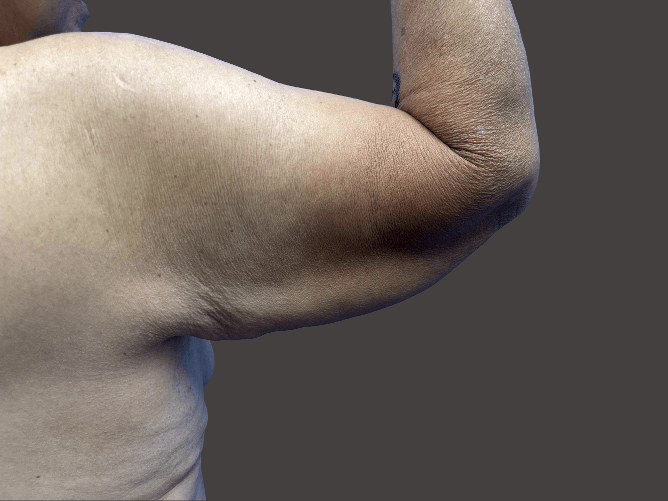 Arm Lift Patient Before - 1
