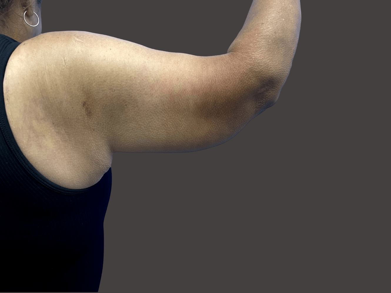 <Arm Lift Patient After - 1