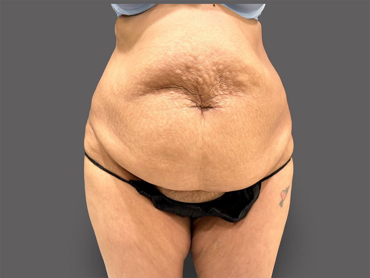 Case--7689-Tummy-Tuck | Before Body
