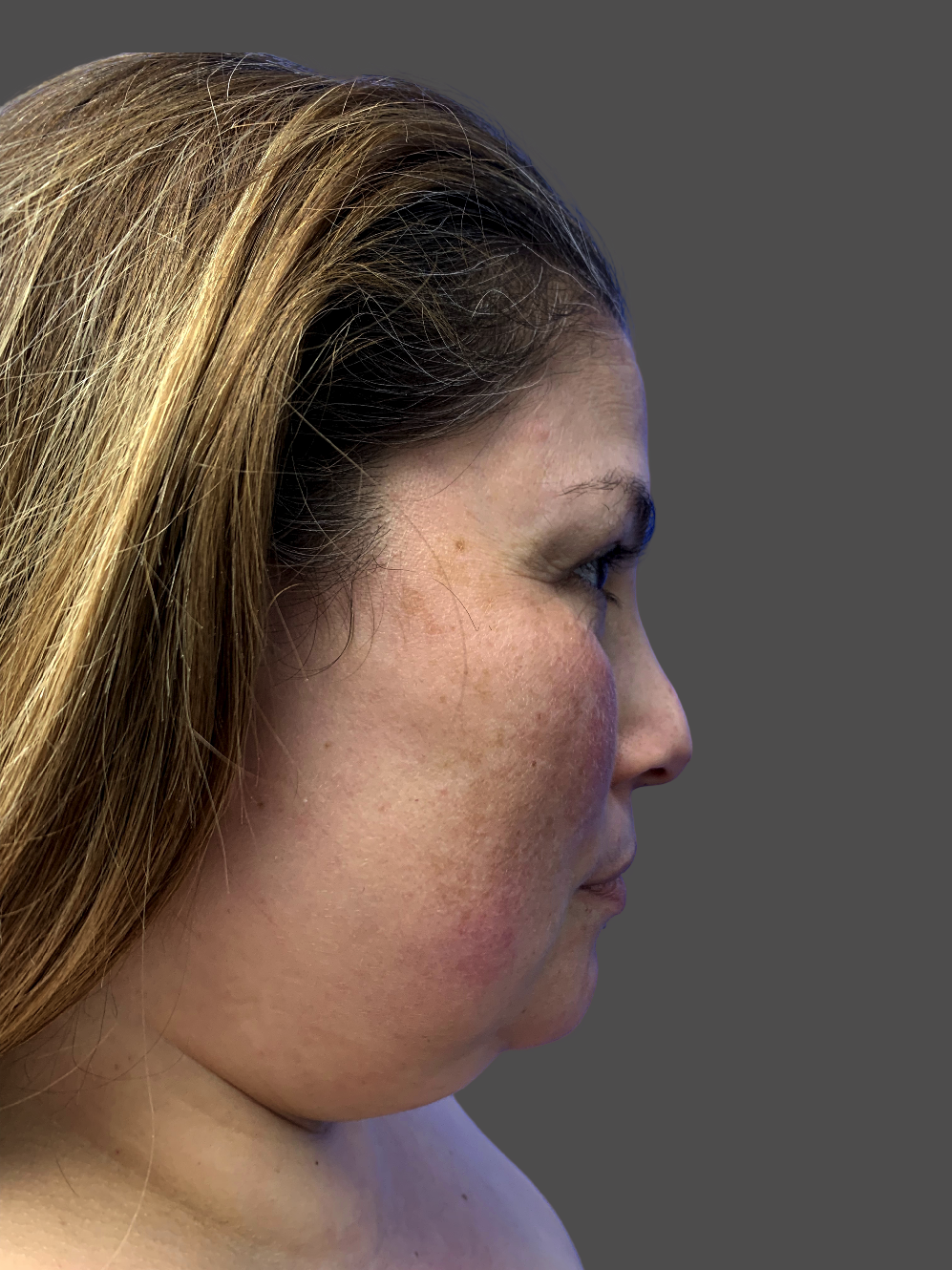 Case--7874-Neck-Liposuction | Before Neck Liposuction