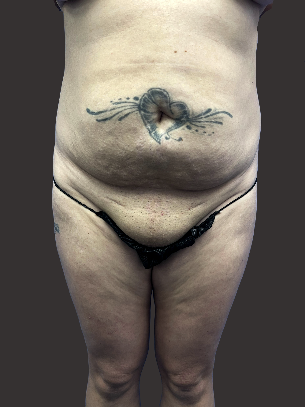 Case--2496-Tummy-Tuck | Before Tummy Tuck