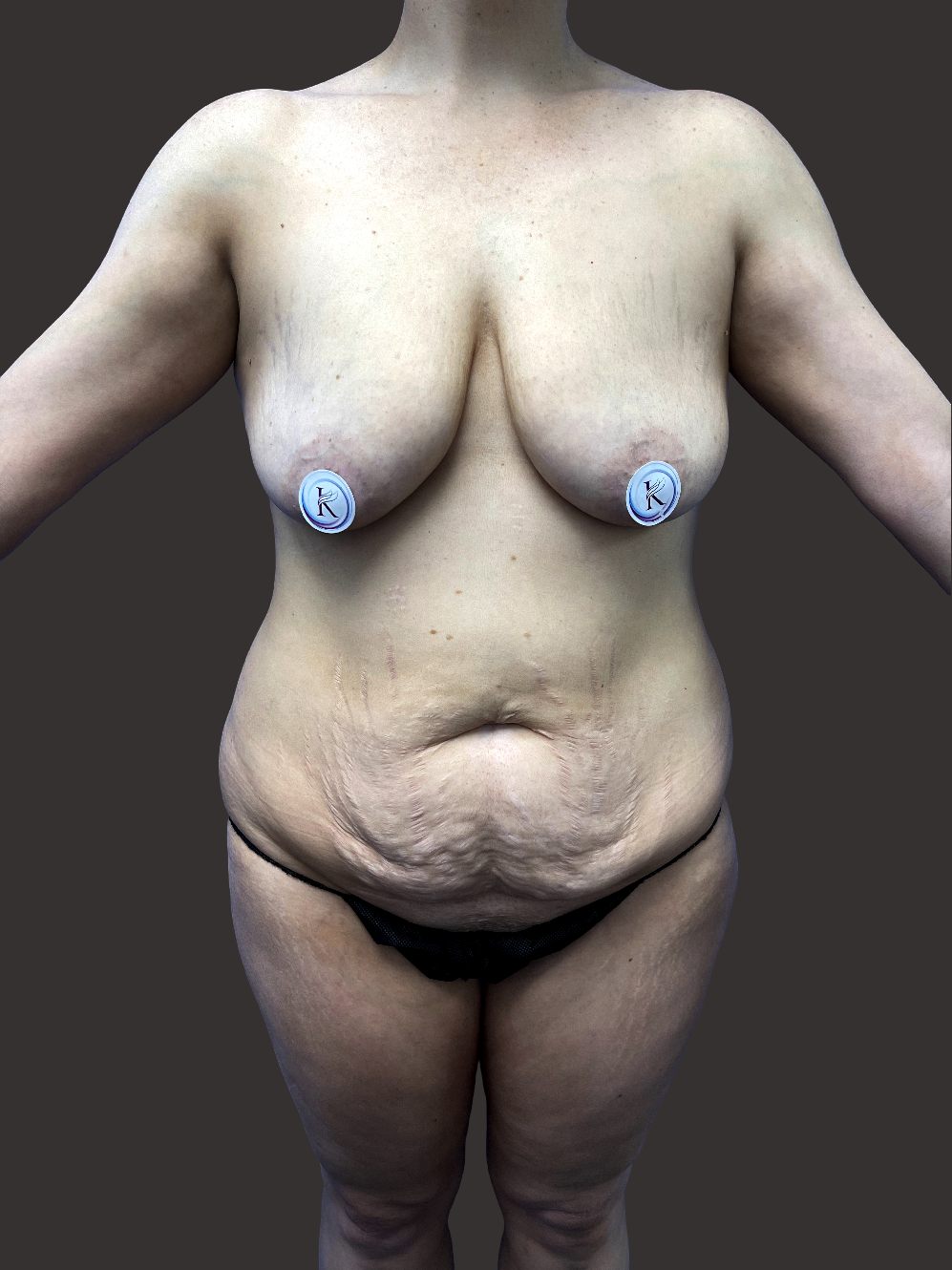 Case--1401-Tummy-Tuck | Before Body