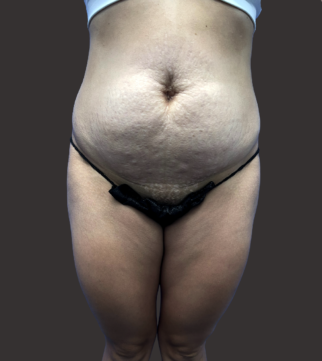 Case--9391-Tummy-Tuck | Before Tummy Tuck