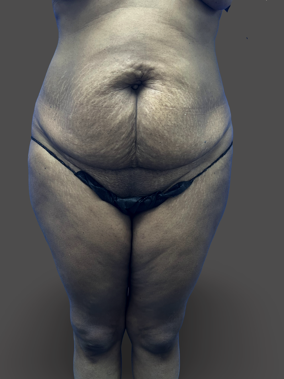 Case--4114-Tummy-Tuck | Before Tummy Tuck