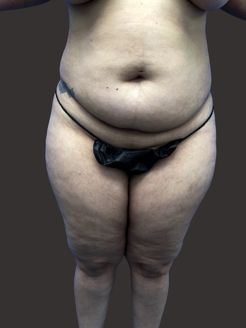 Case--1687-Tummy-Tuck | Before Tummy Tuck