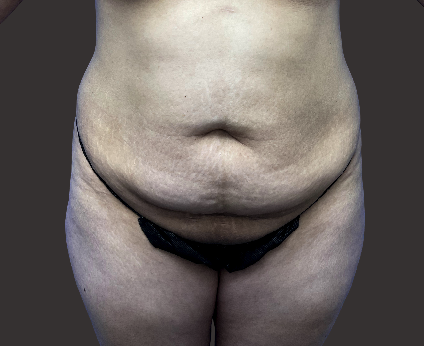 Case--7504-Tummy-Tuck | Before Tummy Tuck
