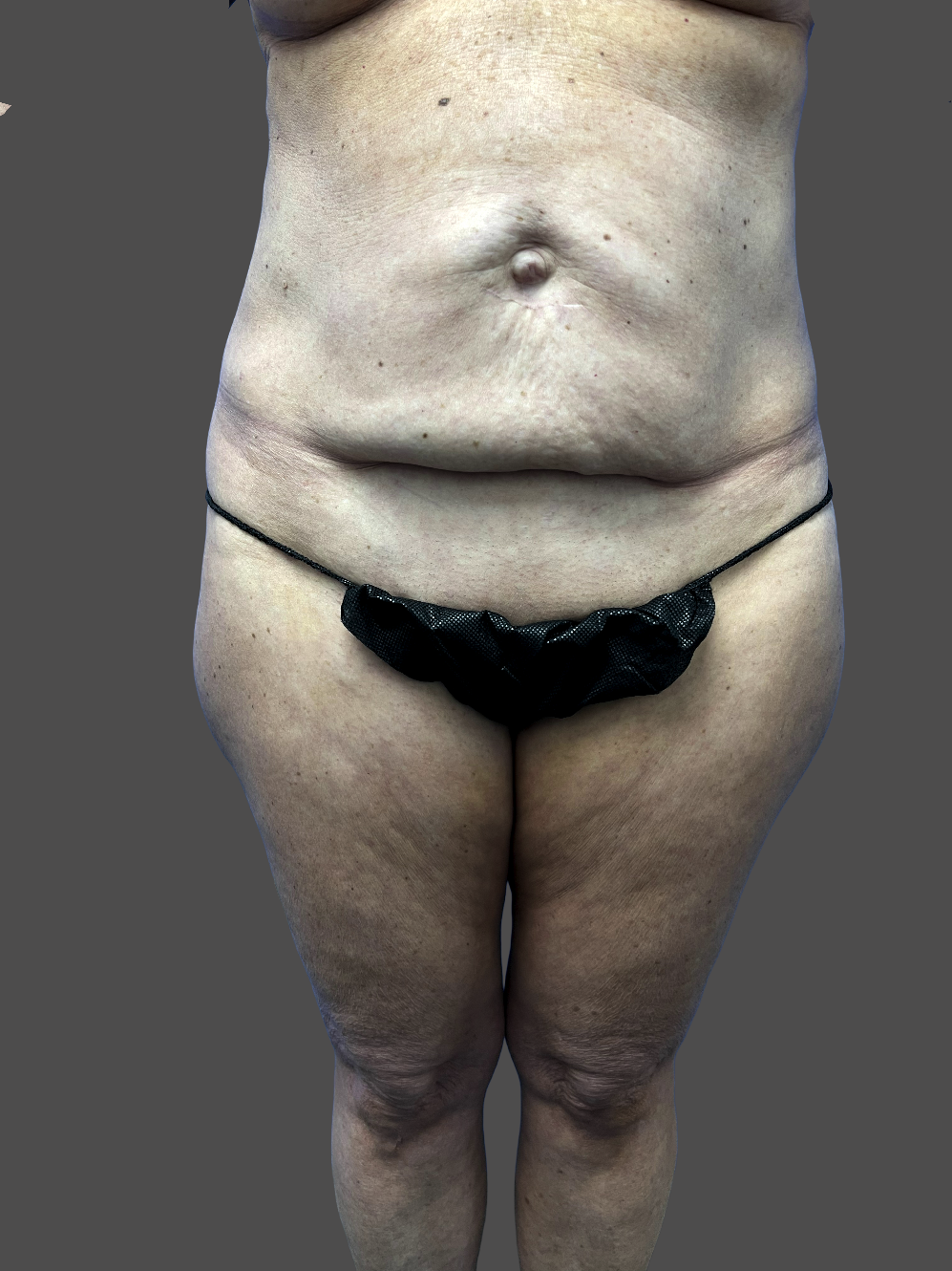 Case--3926-Tummy-Tuck | Before Tummy Tuck