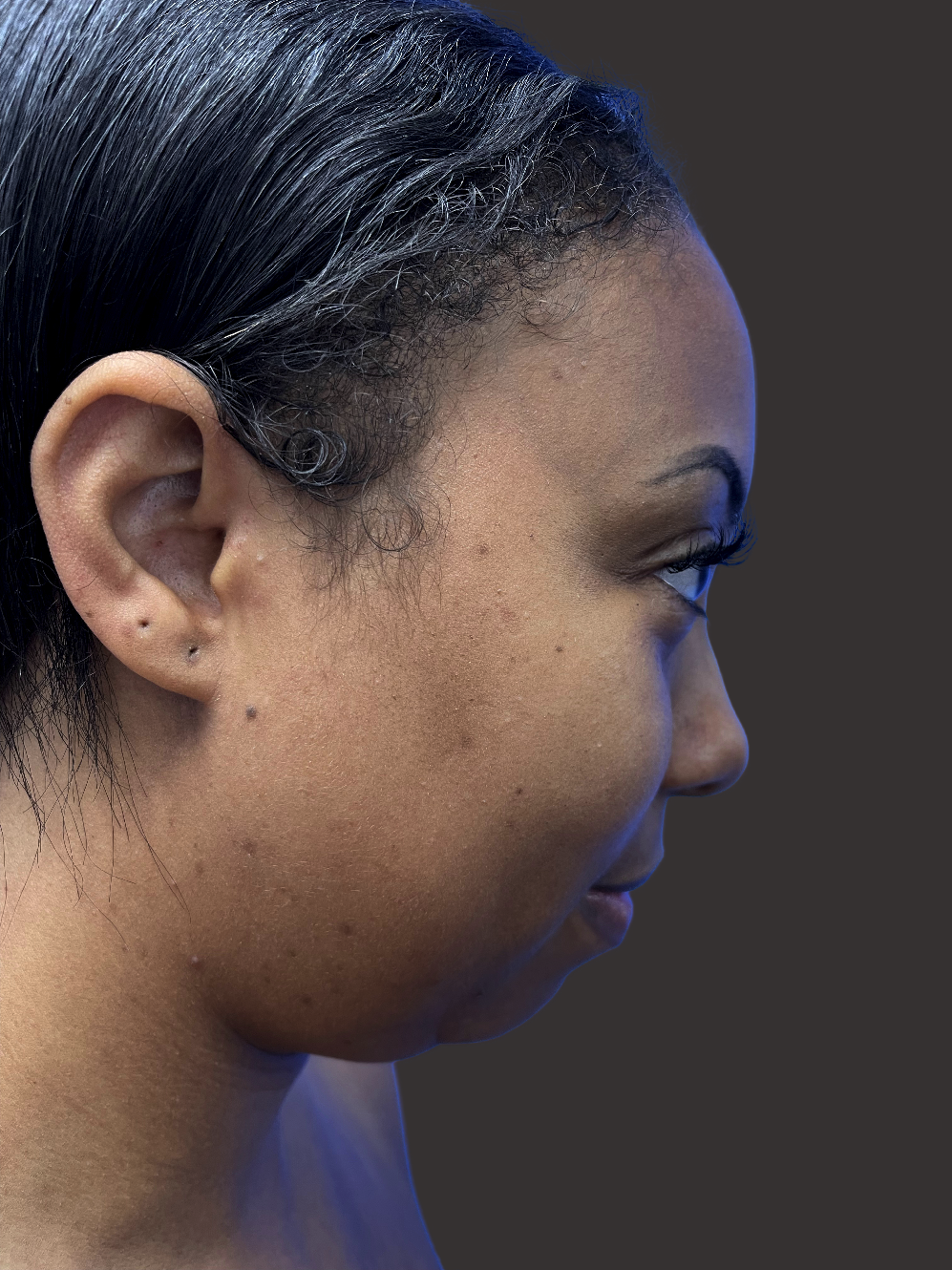 Case--6669-Neck-Liposuction | Before Neck Liposuction