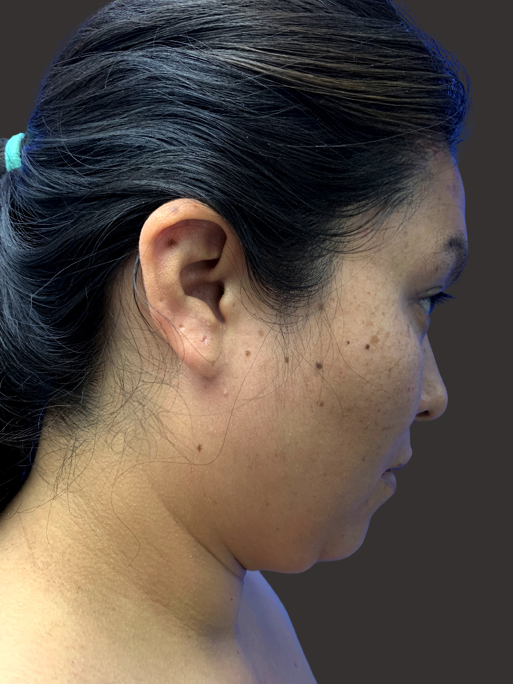 Case--9087-Neck-Liposuction | Before Neck Liposuction