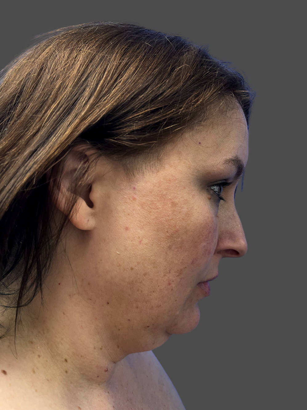 Case--5193-Neck-Liposuction | Before Neck Liposuction