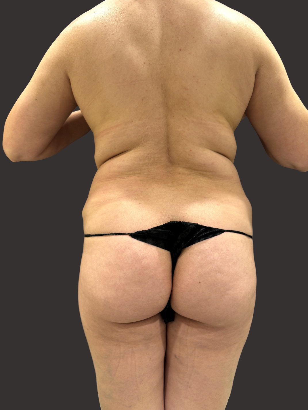 Case--1126-Brazilian-Butt-Lift | Before Body