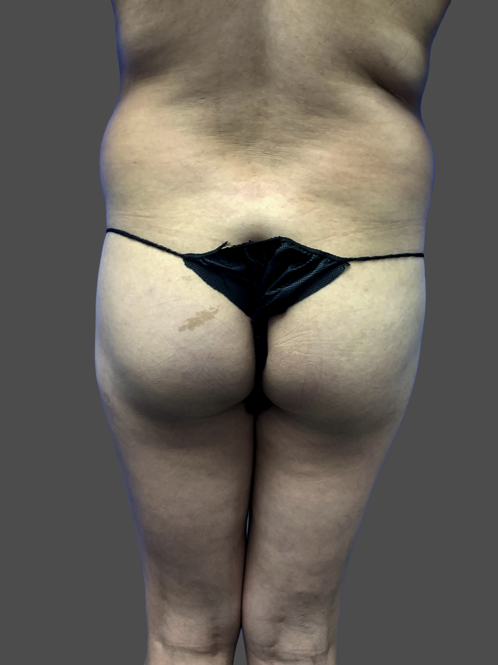 Case--4049-Brazilian-Butt-Lift | Before Body