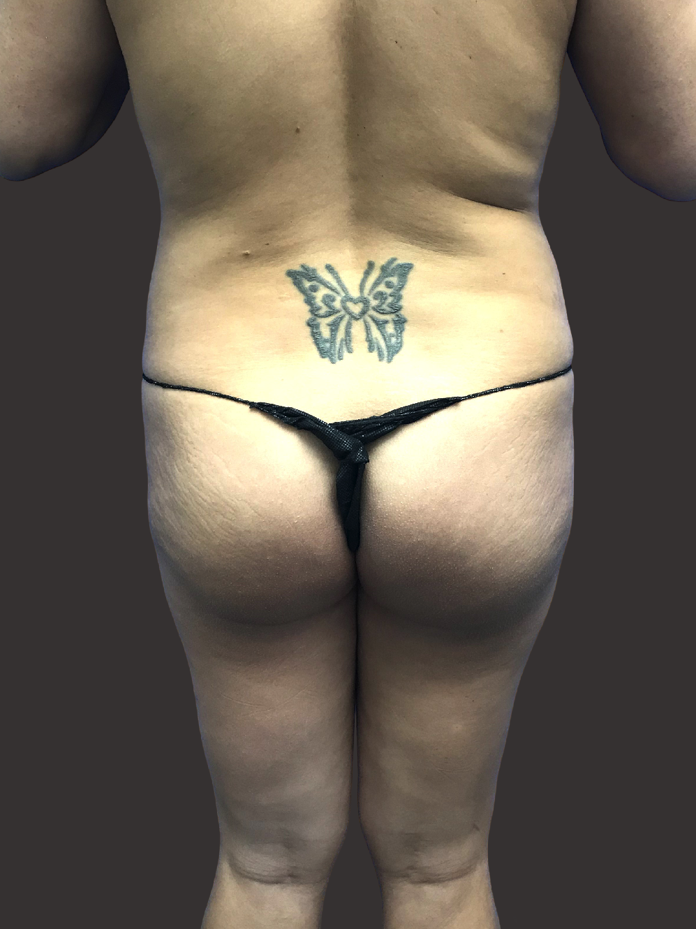 Case--8058-Brazilian-Butt-Lift | Before Brazilian Butt Lift