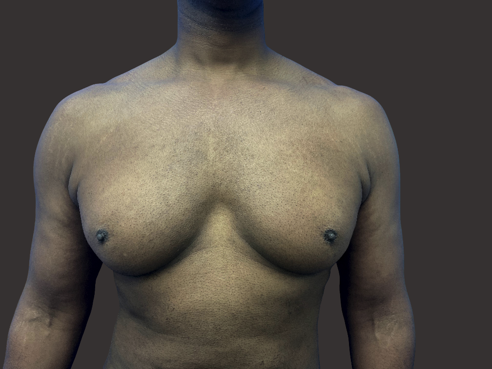 Case--7586-Male-Surgery | Before Male Surgery