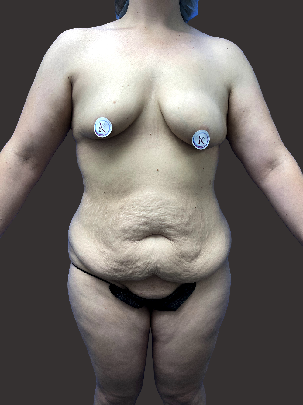 Case--5418-Breast-Lift | Before Breast Lift