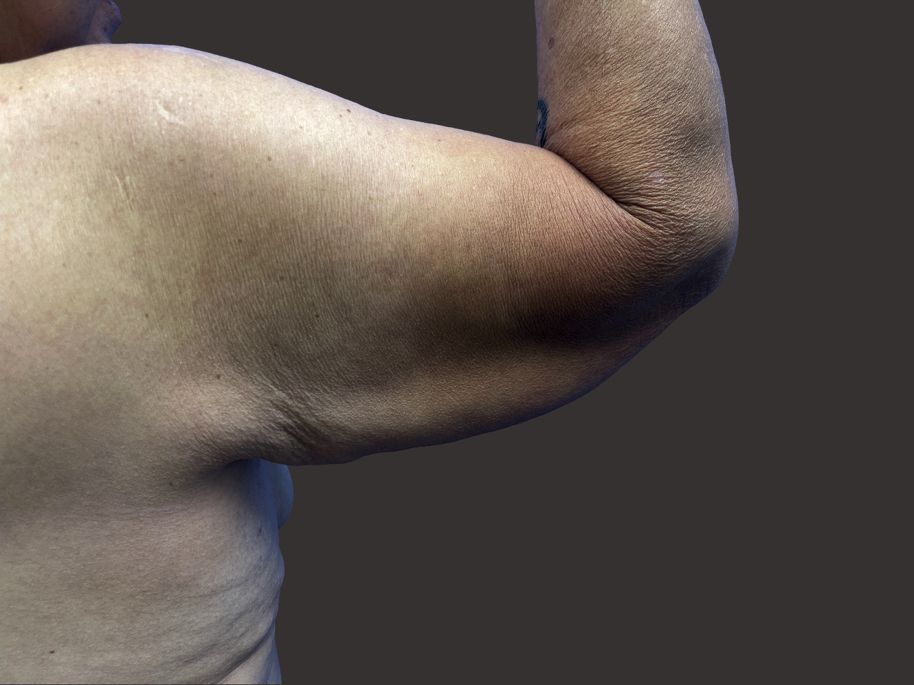 Case--1630-Arm-Tuck | Before Body