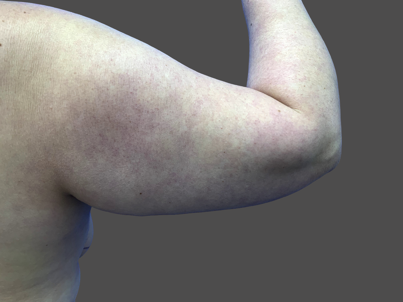 Case--4301-Arm-Tuck | Before Body