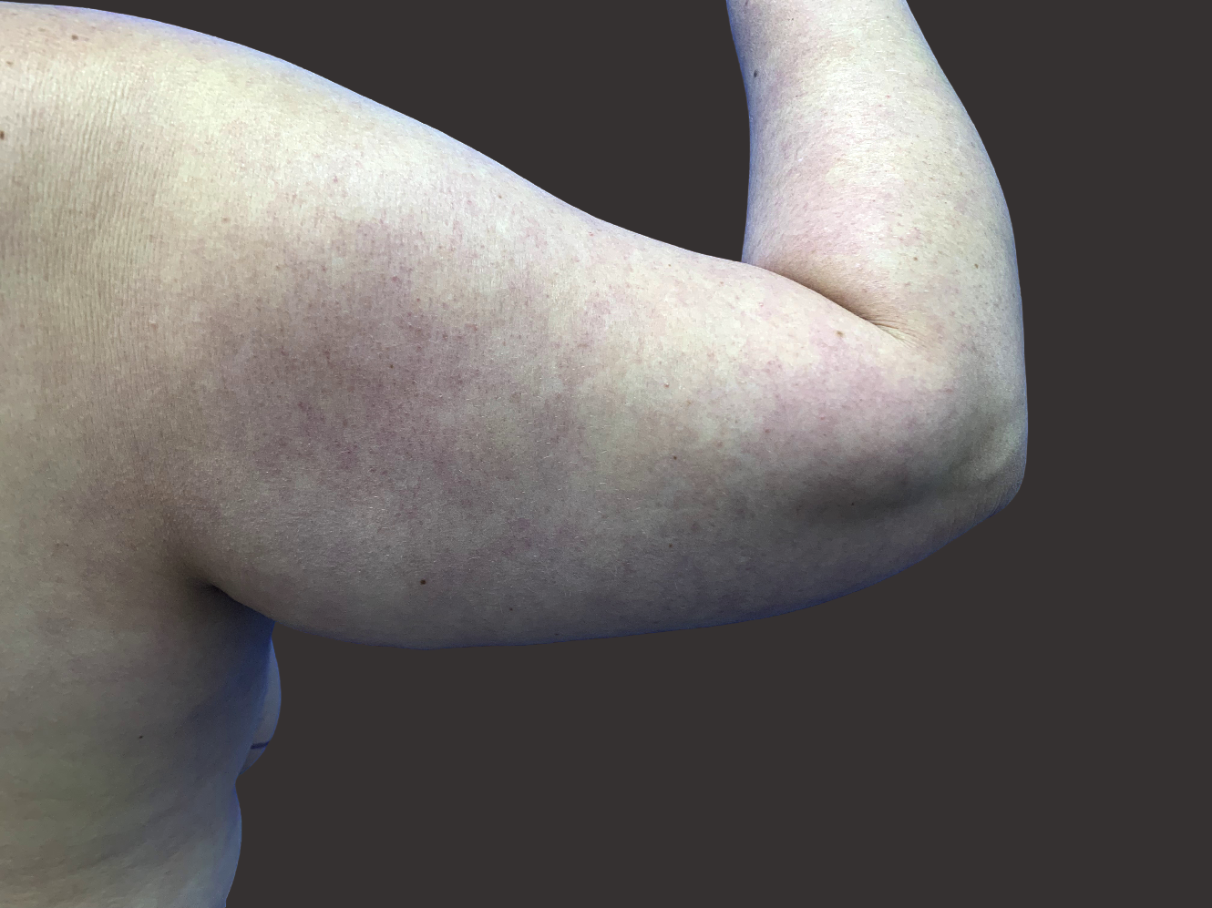 Case--7430-Arm-Tuck | Before Body