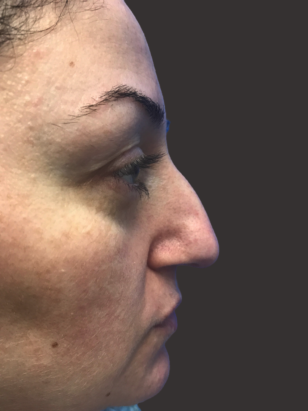 Case--3927-Rhinoplasty | Before Rhinoplasty