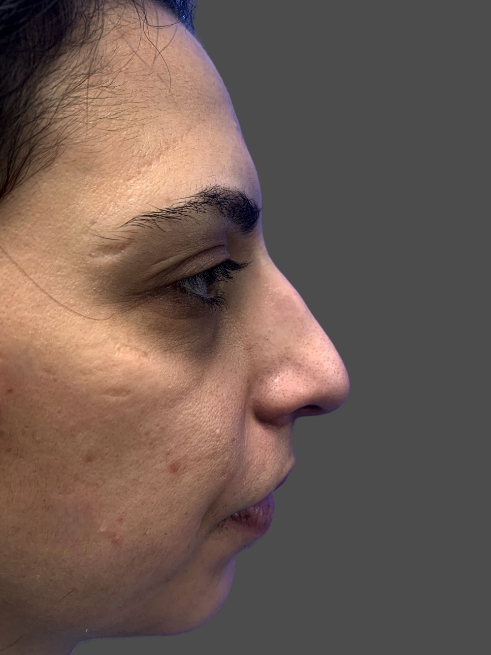 Case--7708-Rhinoplasty | Before Rhinoplasty