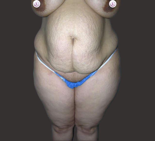 Case--7203-Post-Massive-Weight-Loss-Surgery | Before Body