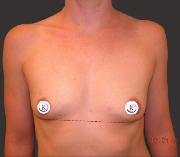 Case--9589-Breast-Augmentation | Before Breast Augmentation