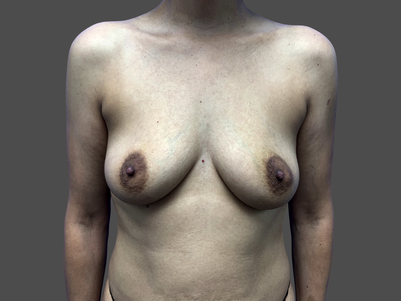 Case--5894-Breast-Augmentation | Before Breast Augmentation