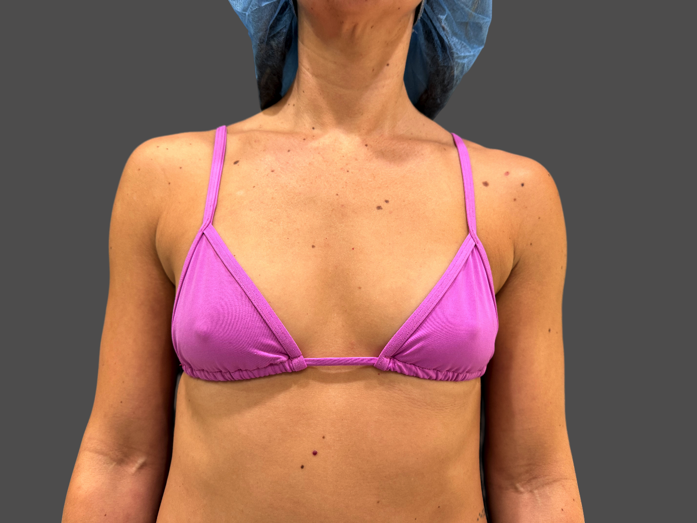 Case--7879-Breast-Augmentation | Before Breast Augmentation