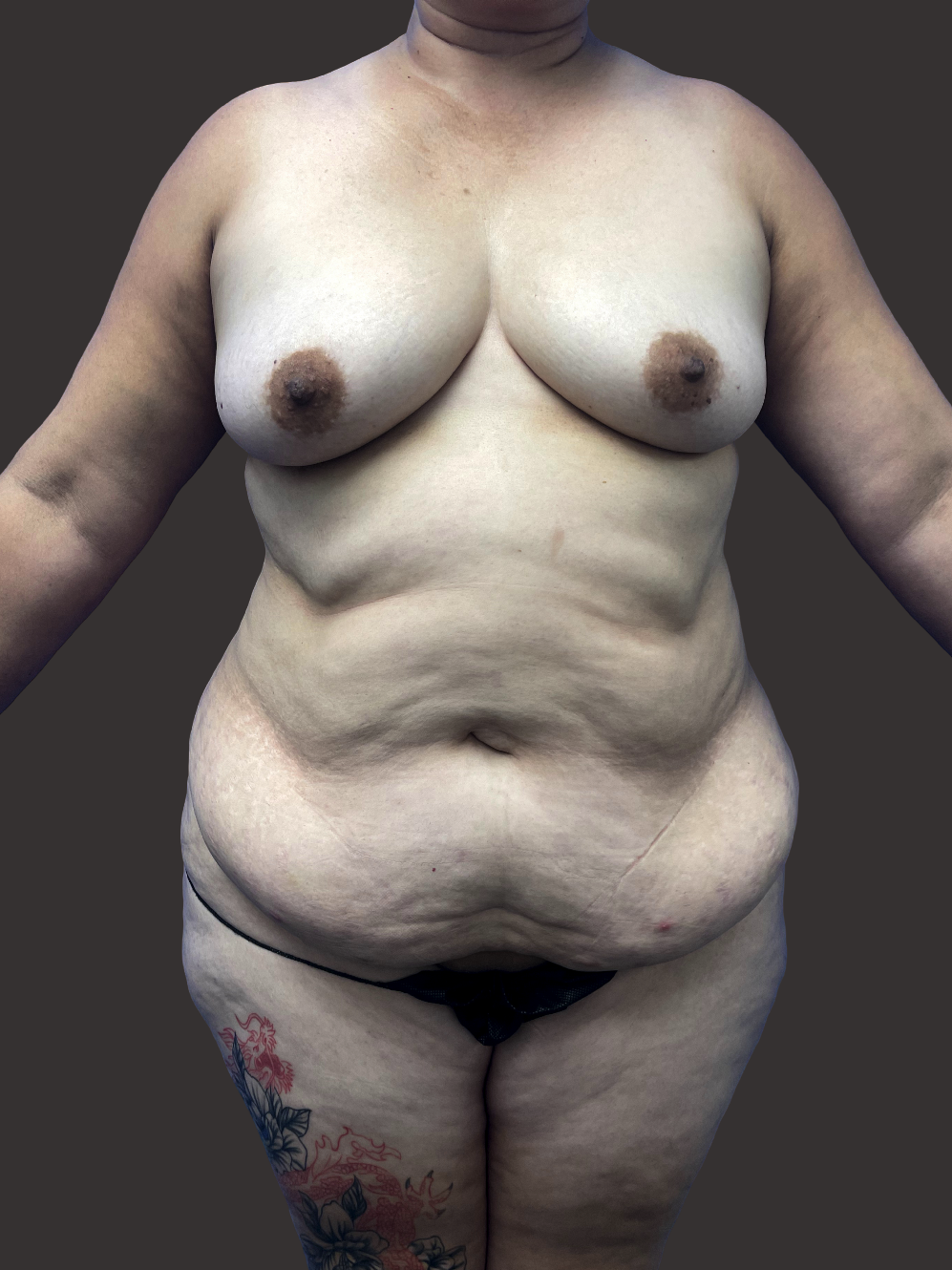 Case--7681-Mommy-Makeover | Before Body