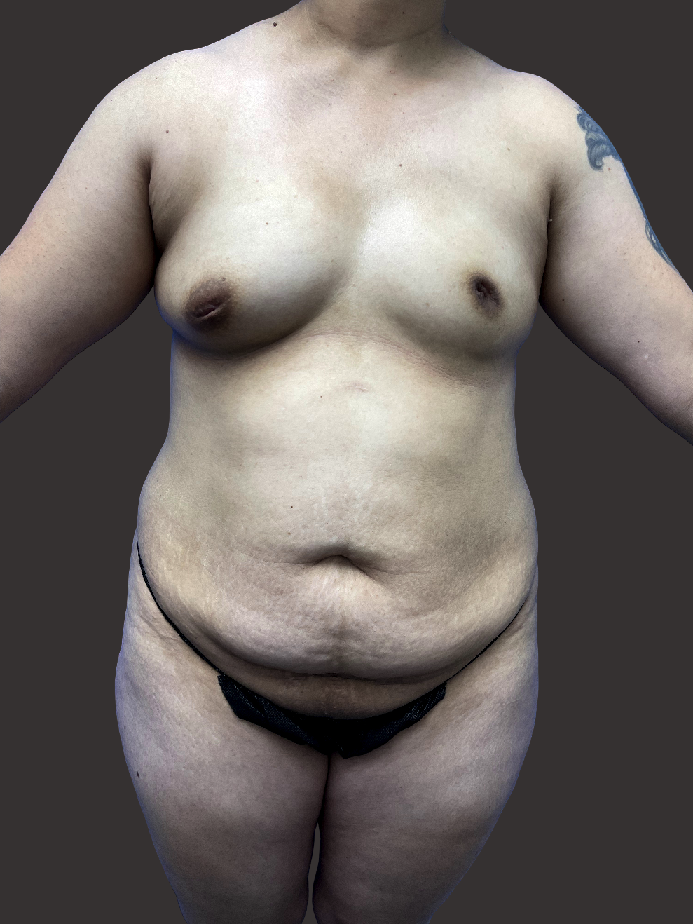 Case--8601-Mommy-Makeover | Before Body