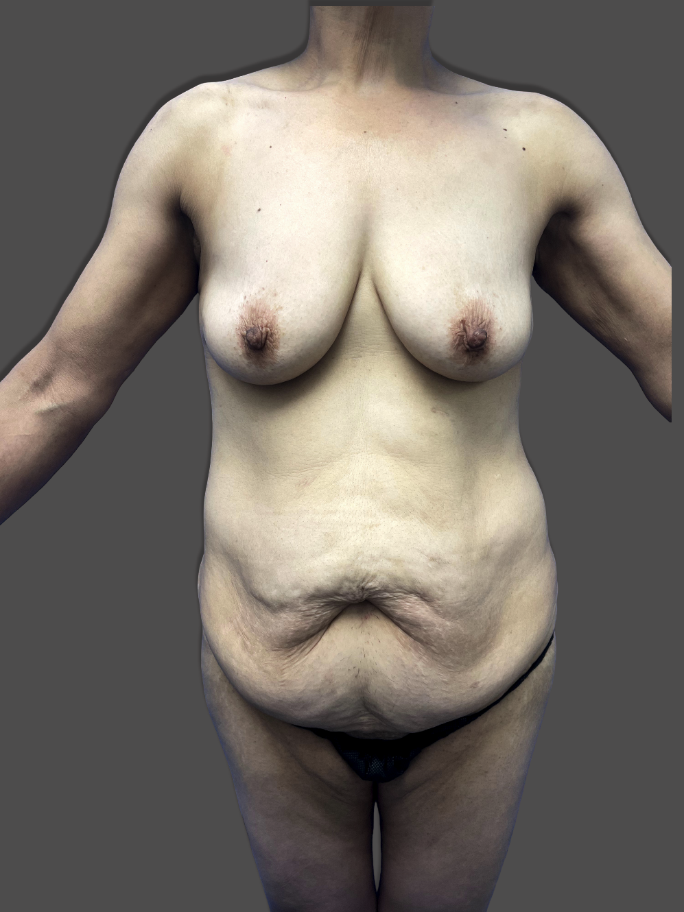 Case--3754-Mommy-Makeover | Before Mommy Makeover