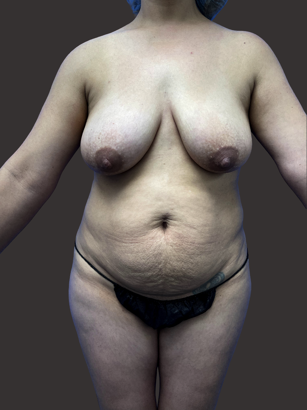 Case--4162-Mommy-Makeover | Before Mommy Makeover