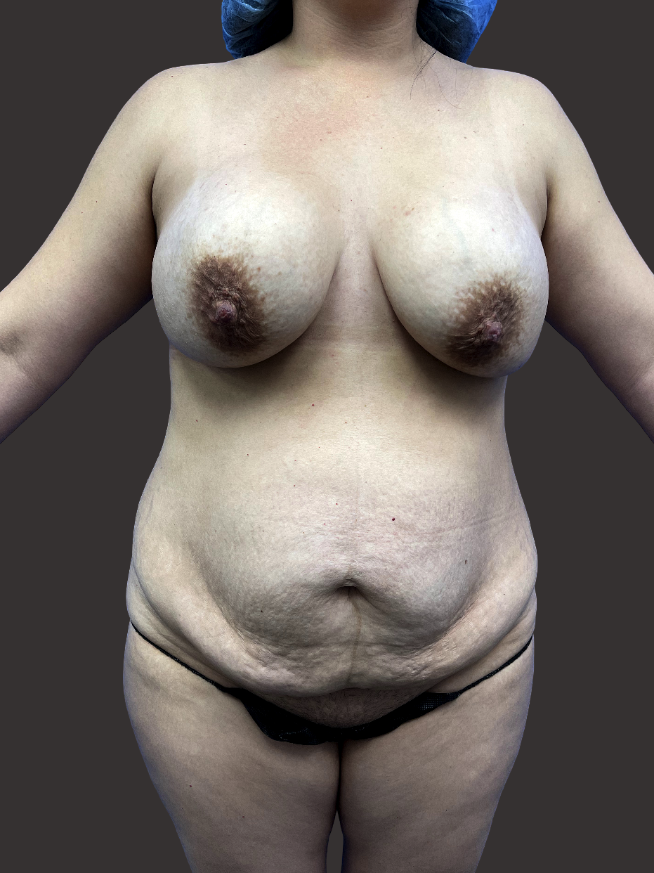 Case--5534-Breast-Implant-Revision | Before Breast Implant Revision