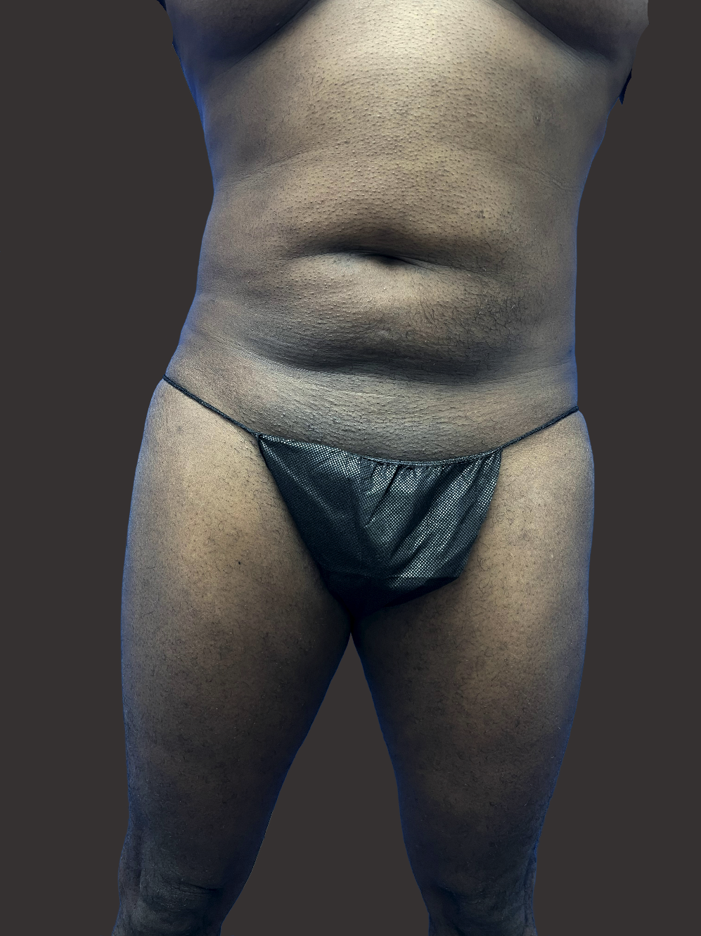 Case--4323-Male-Surgery | Before Male Surgery