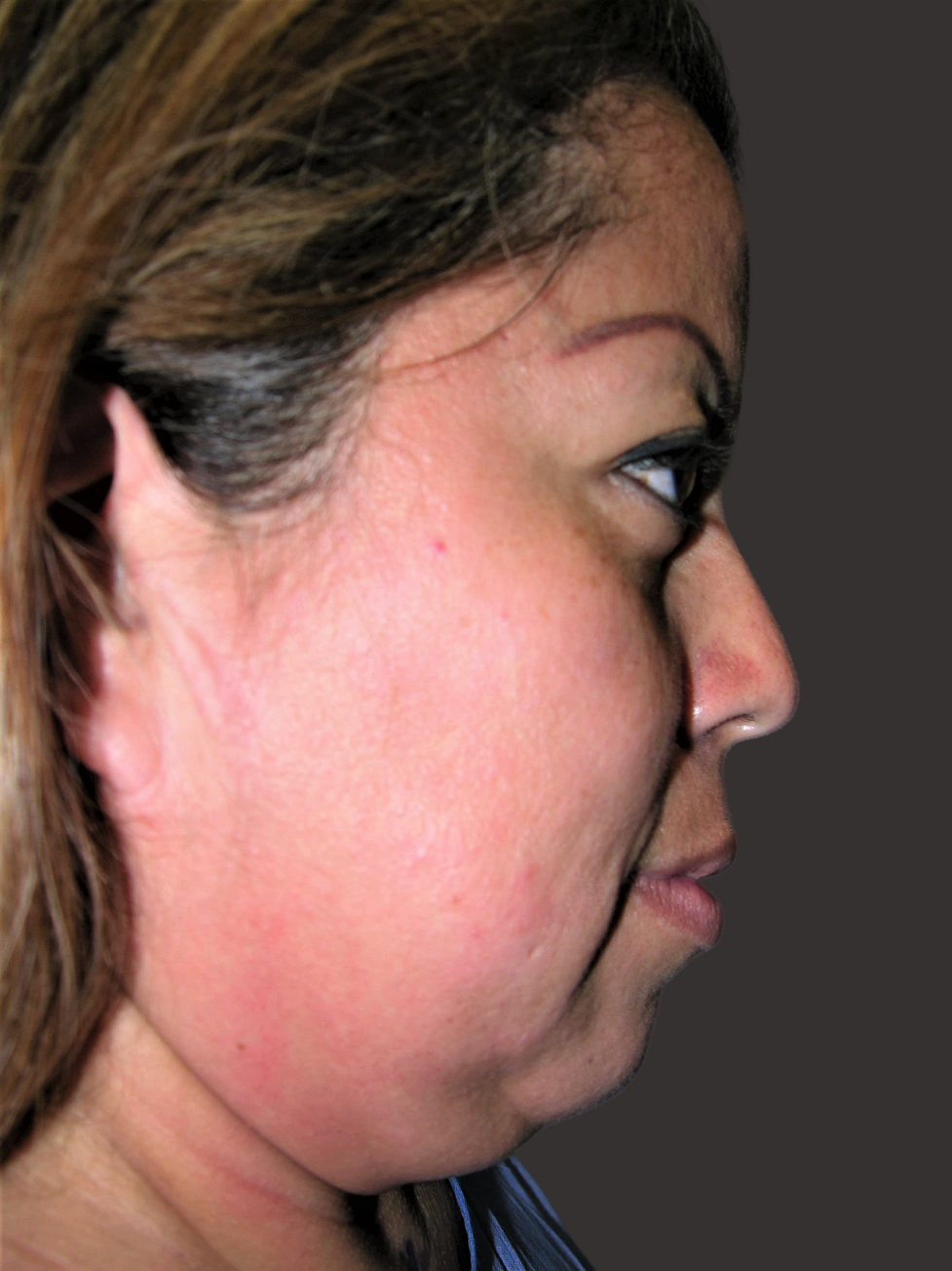 Case--5934-Neck-Liposuction | Before Neck Liposuction