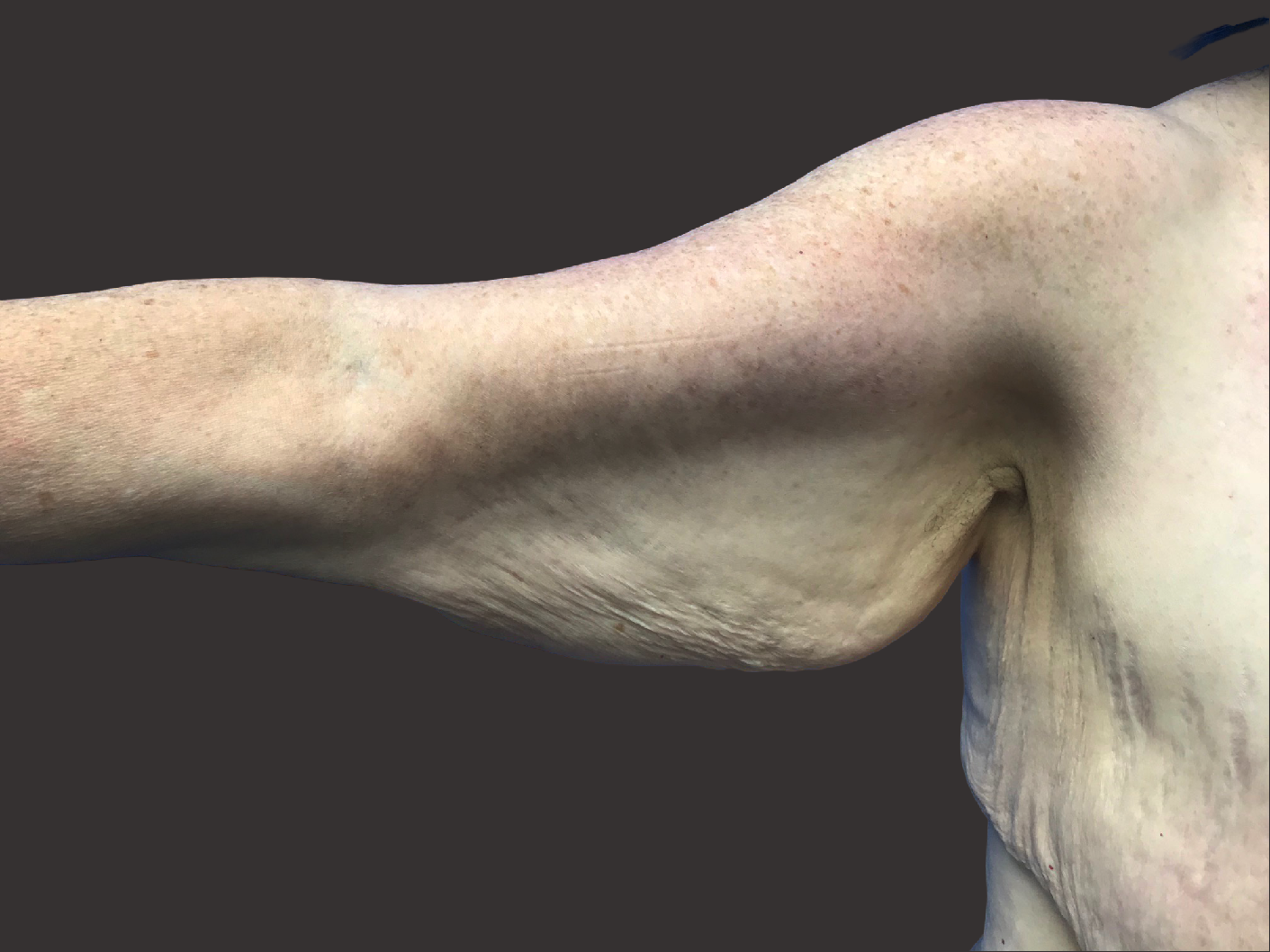 Case--1423-Arm-Tuck | Before Body