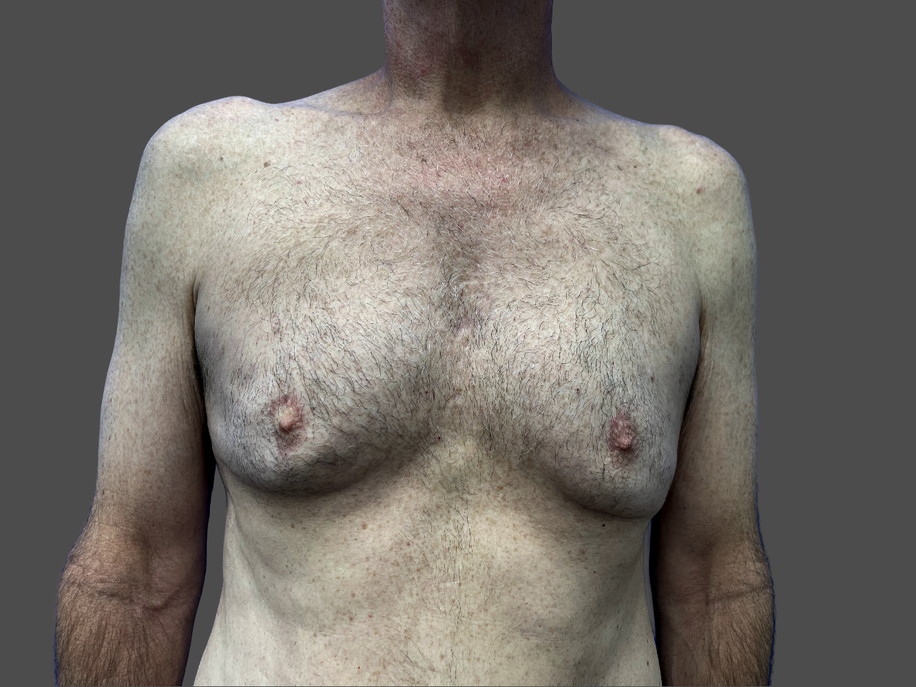 Case--9537-Male-Surgery | Before Male Surgery
