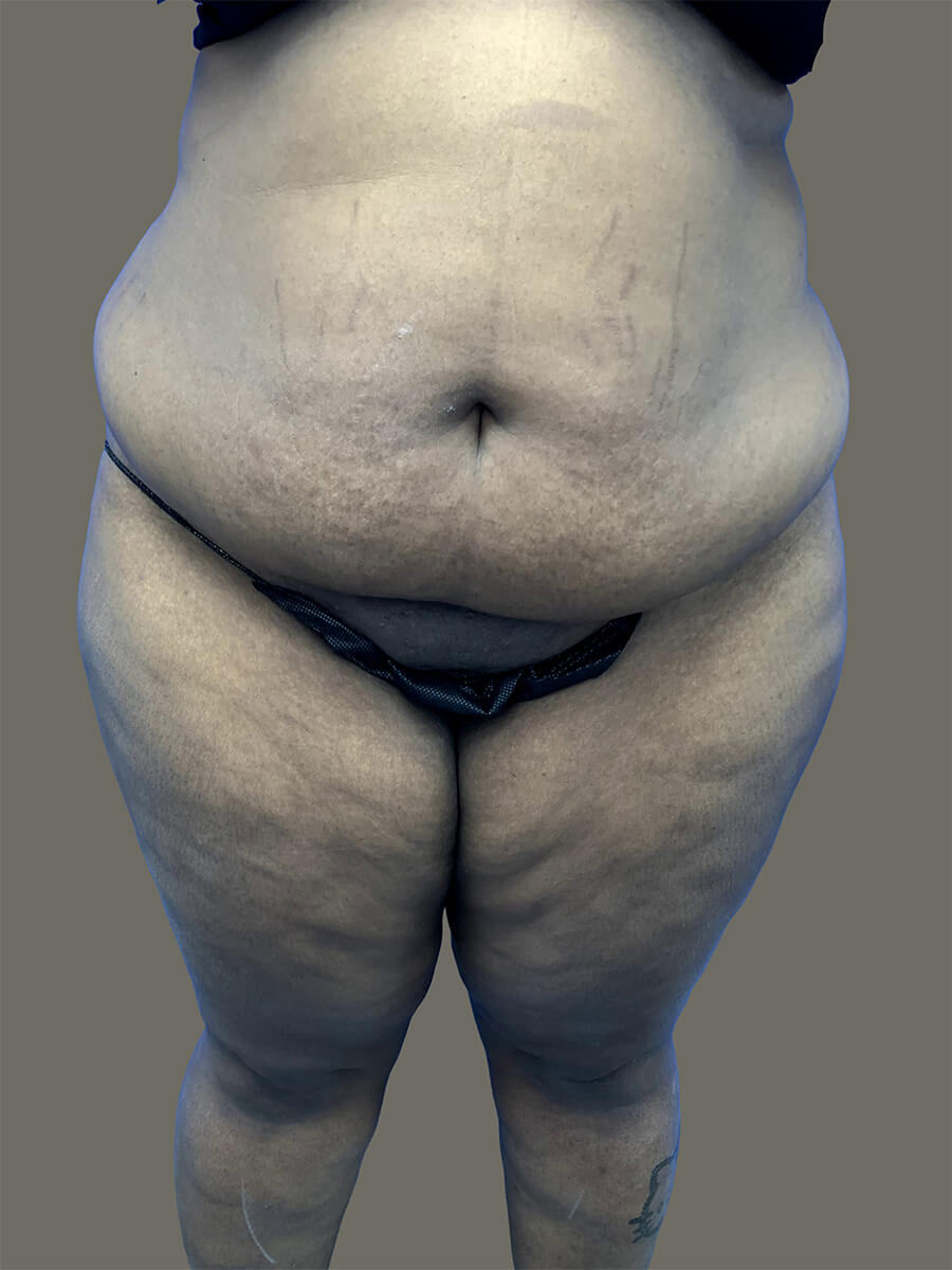 Case--1934-Tummy-Tuck | Before Body